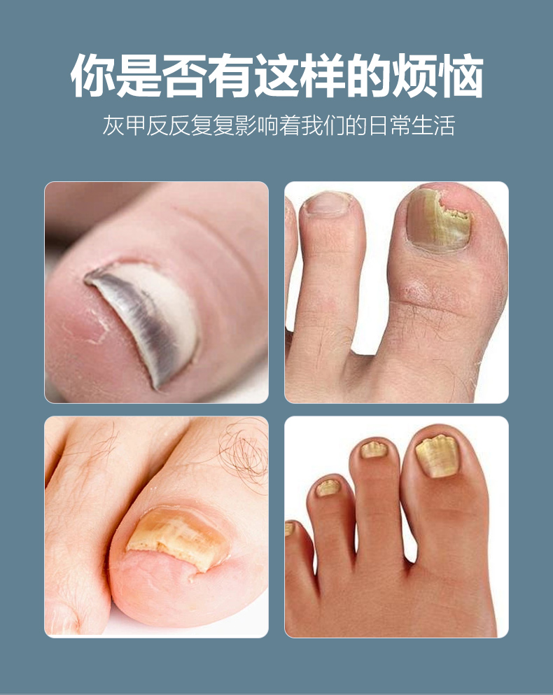 灰指甲保健液